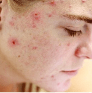 Hormone-Imbalance-Symptom-What's-Yours-Acne