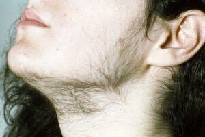 Hormone-Imbalance-Hirsutism-in-Women-Hirsutism