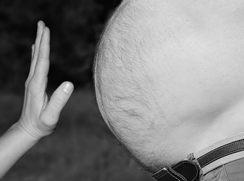 Obesity-and-Hirsutism-Overweight-and-Excessive-Hair-Growth-Obese-Hirsute